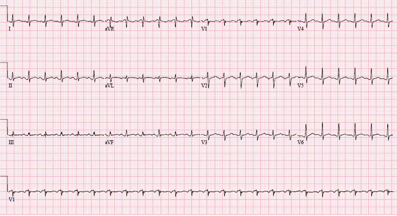 Presenting ECG — Three More ECG Pitfalls That Punish Anchoring Bias