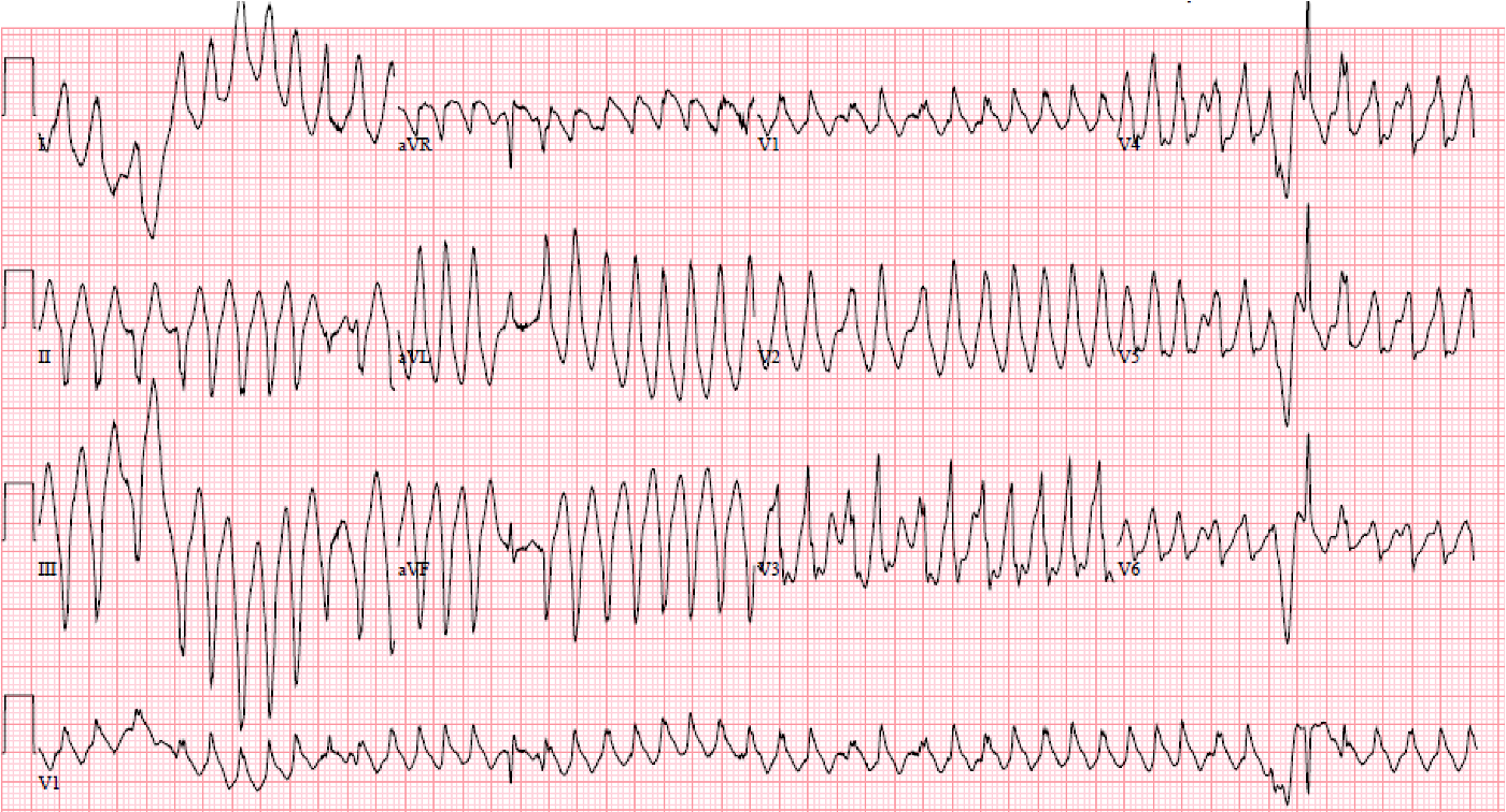 Presenting ECG — Preexcitation Pitfalls (Part 3): Wide, Irregular, Fast...Avoid AV Nodal Blockers