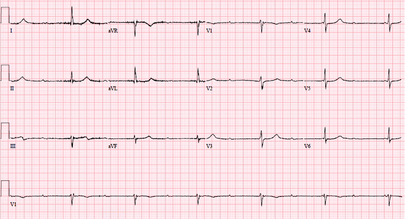 Presenting ECG — UMEM Cases, Part 2: When the ECG Conceals and When It Reveals