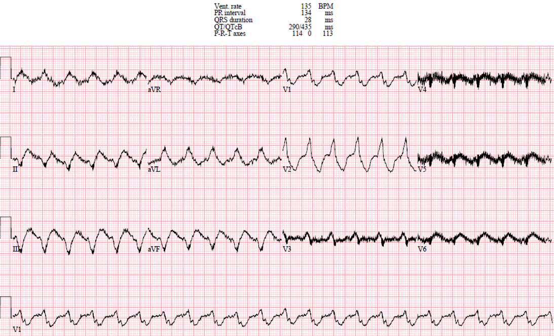 Presenting ECG — UMEM Cases, Part 4: When the Computer Misses the Rhythm and Flutter Fakes a STEMI