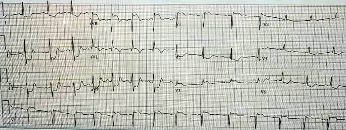 Presenting ECG — Three High Risk ECGs and the Right Next Move