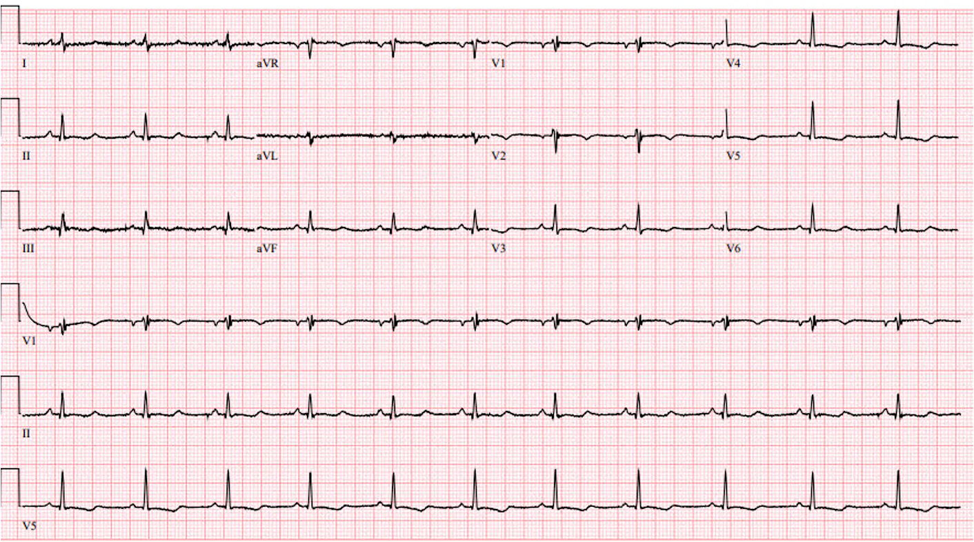 Presenting ECG — UMMC Cases Part III: When T Waves Help Tell the Story