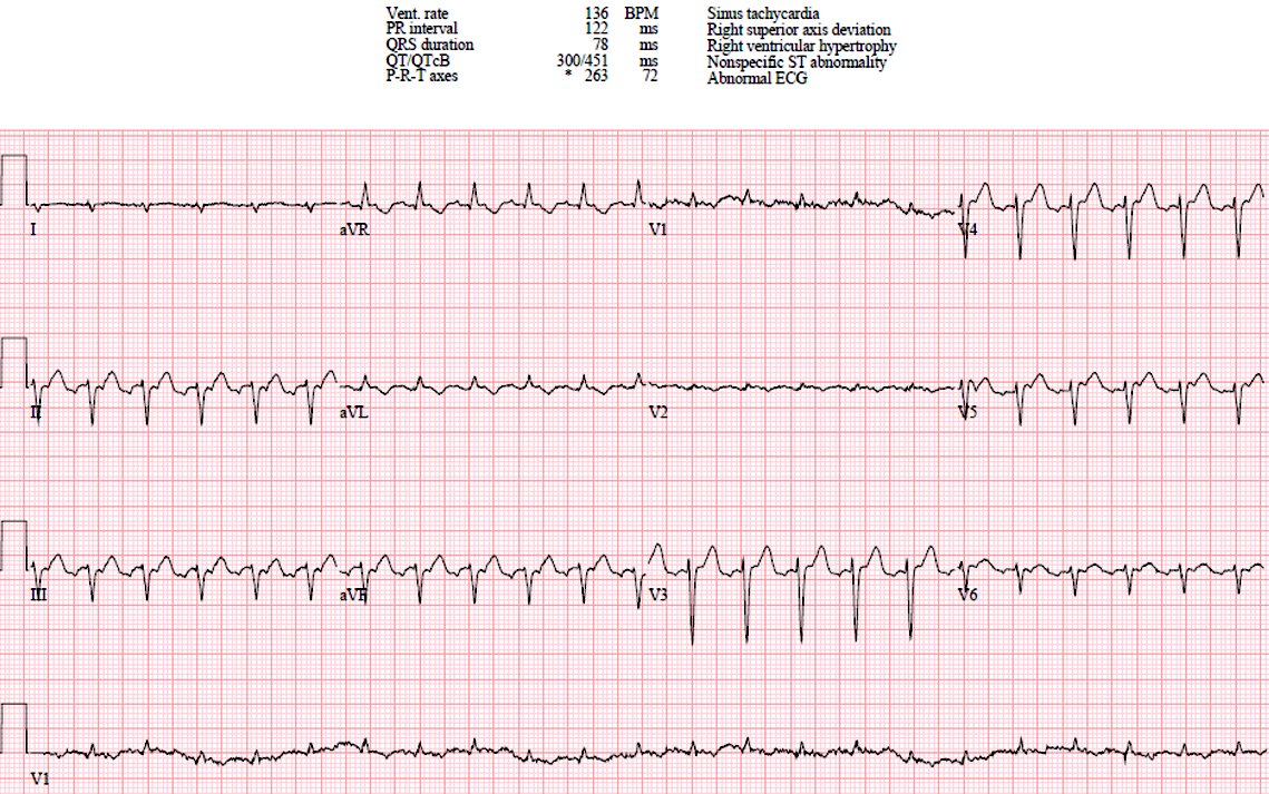 Presenting ECG — UMMC Cases Part IV: Two Easily Missed ECG Diagnoses