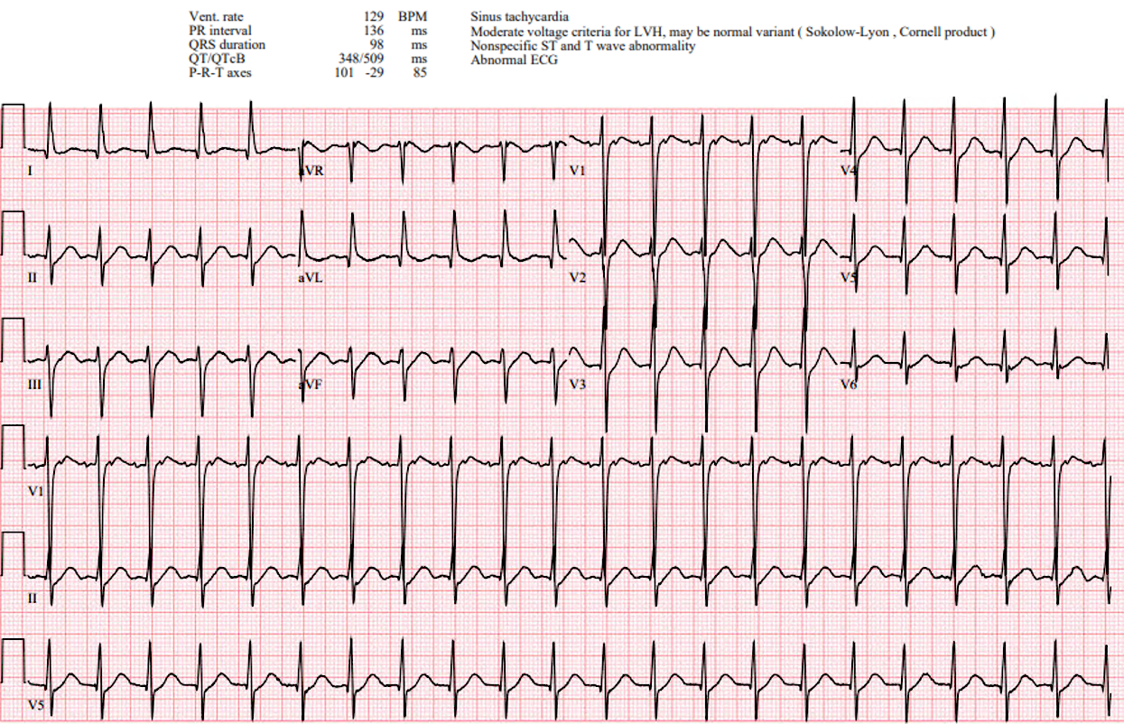 Presenting ECG — ECG Hallucinations: The Rhythms You See and the Rhythms You Miss