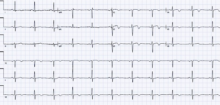 Presenting ECG — Chest Pain: When “Nonspecific” ECG Abnormalities Are Not Reassuring