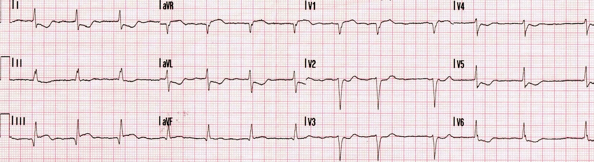 ECG Insights From the Fifth Universal Definition of MI – ECG Weekly